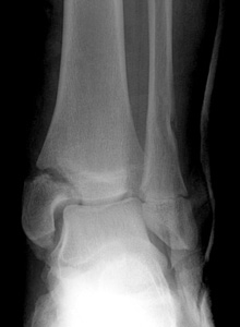 Figure 5 Salter Harris III distal tibia physeal_AP Figure 5 Salter Harris III distal tibia physeal_AP